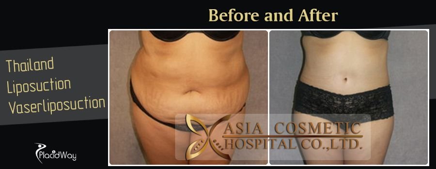 Liposuction Procedure in Thailand Before and After Images